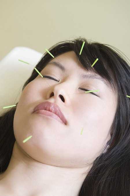 A woman during facial acupuncture treatment