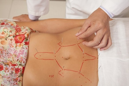 Acupuncture on the stomach 