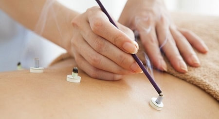 Mugwort tablets being used for moxibustion therapy in richmond hill