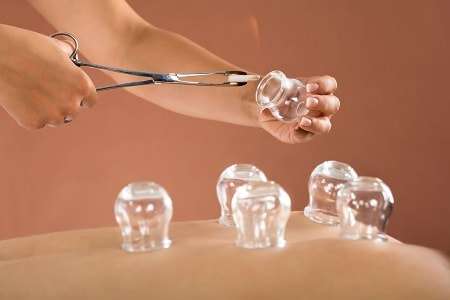 A patient receiving cupping therapy